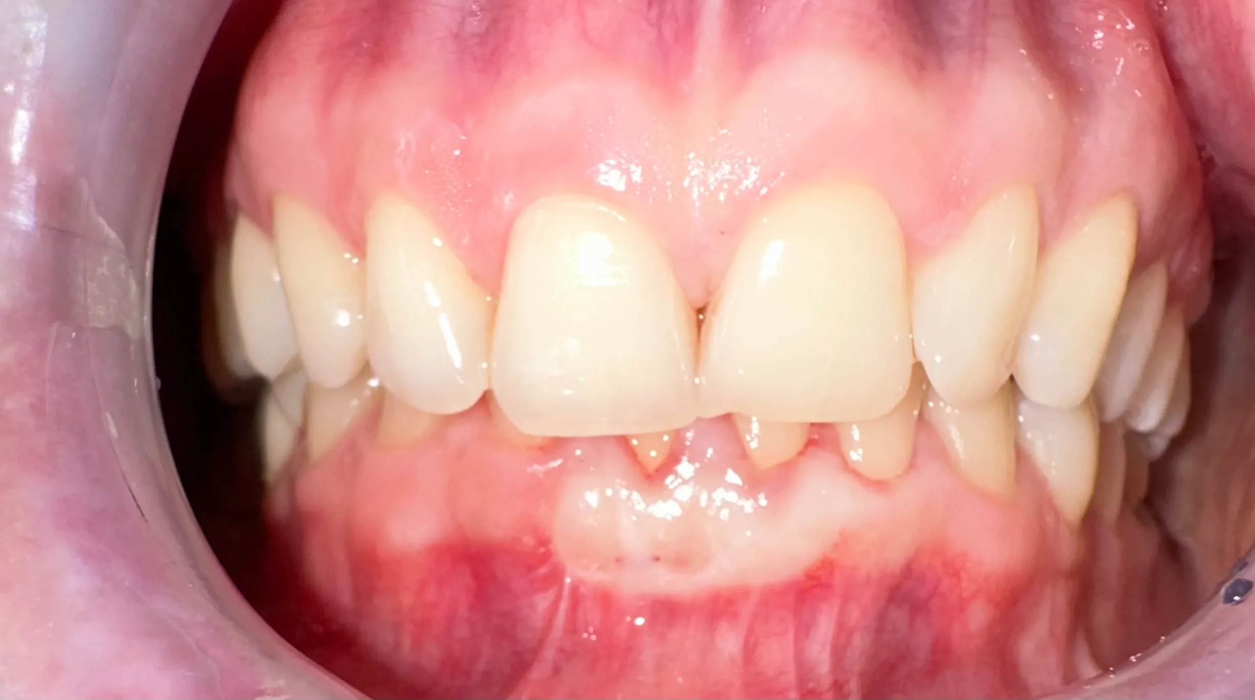 Același incisiv după acoperirea retracției cu grefă gingivală din palat