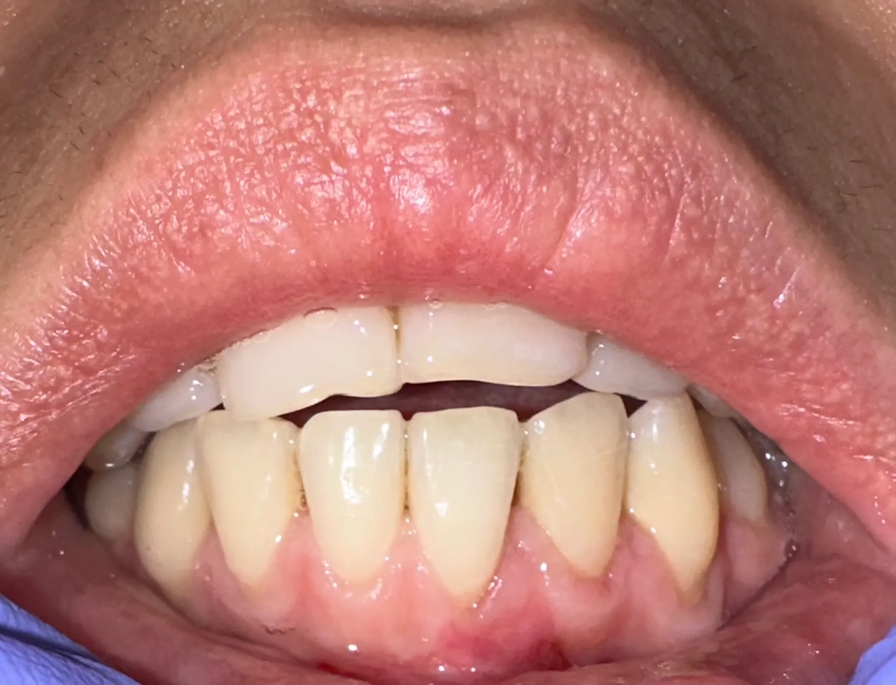 Același incisiv după chirurgie mucogingivală și grefă gingivală