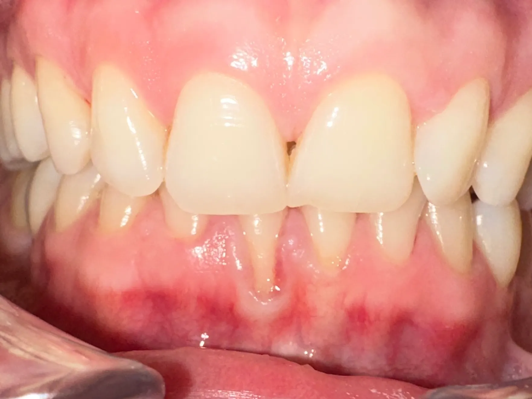 Retracție gingivală la un incisiv inferior, cu rădăcina expusă