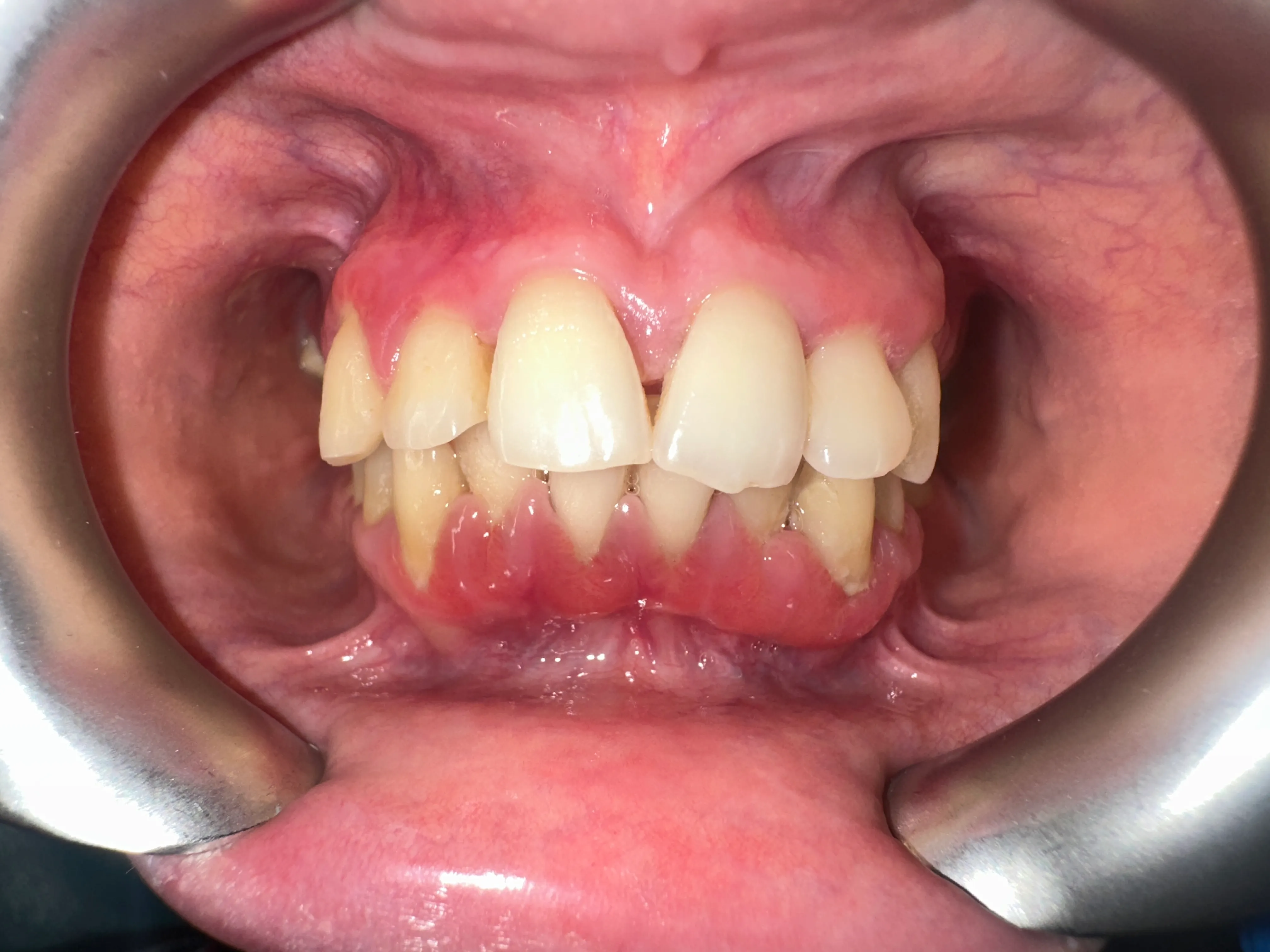 Gingii inflamate și înghesuiri dentare, înainte de tratamentul parodontal